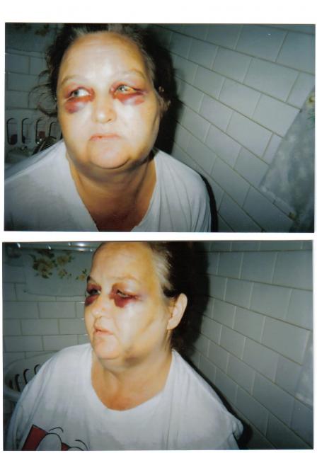 rita_hart_injury_assualt.jpg
